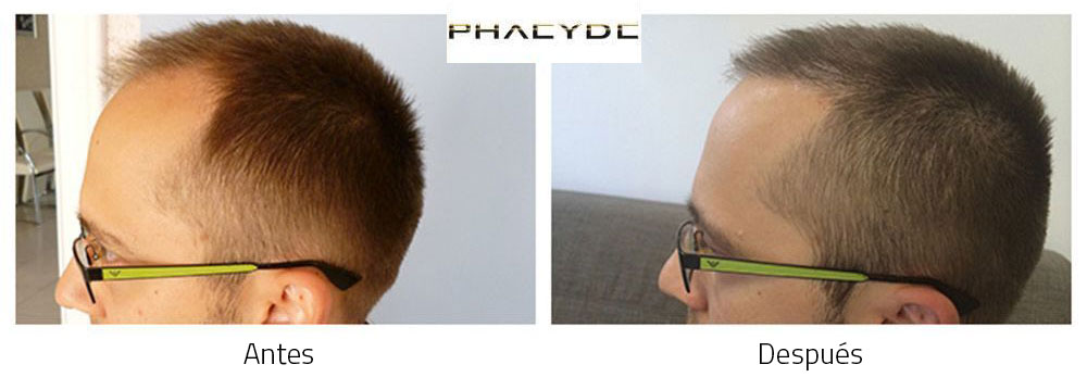 Transplante de cabello Aron P. 4000 Pelo