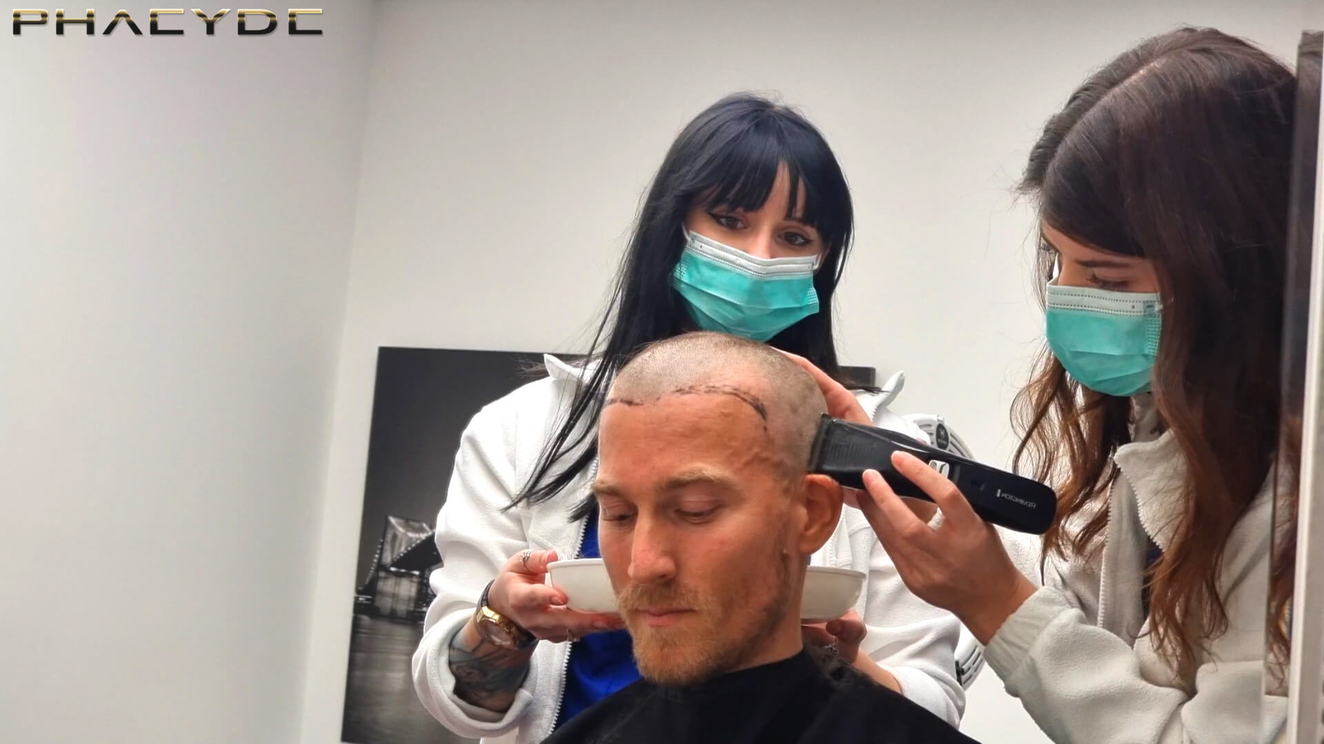 8+1 Myths About Hair Transplantation