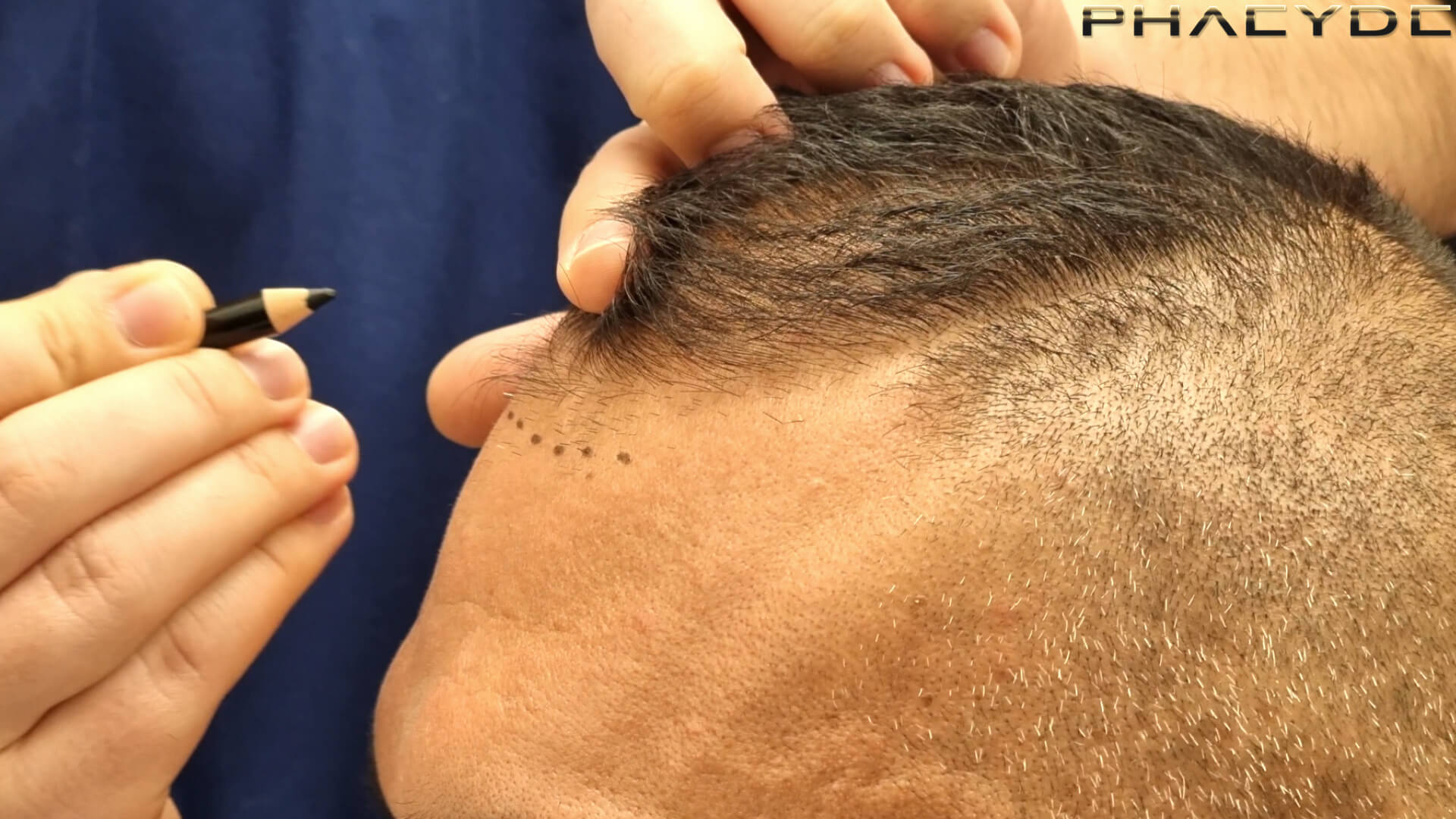 PHAEYDE Hair Transplant Clinic