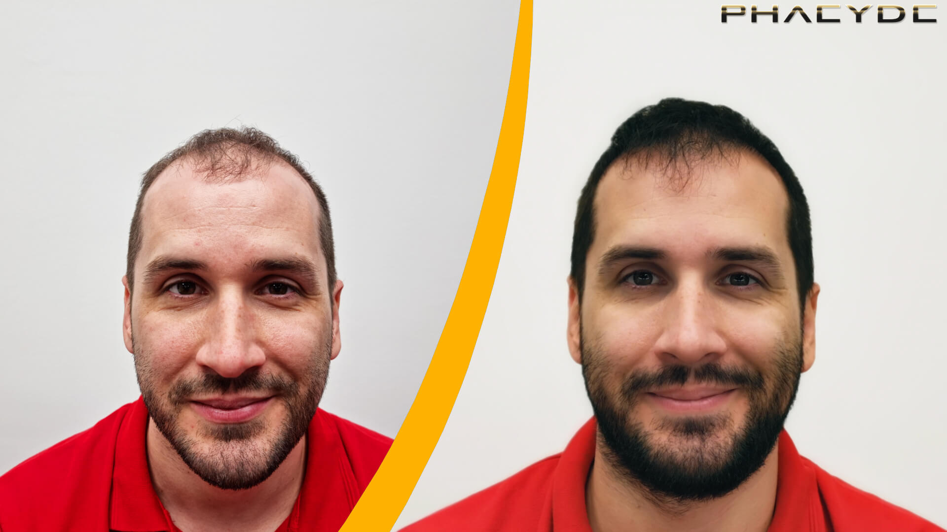 Resultados de Trasplante de Cabello Antes y Después