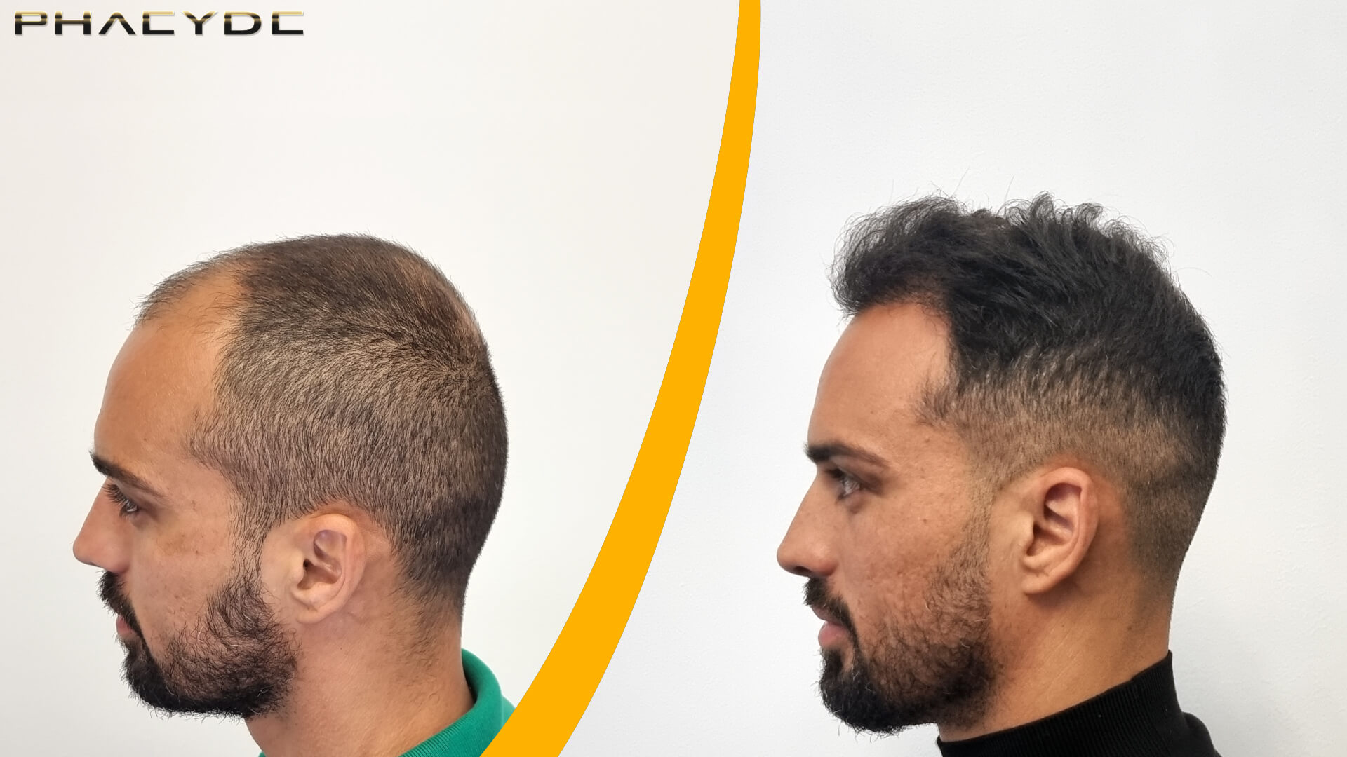 Trasplante de Cabello - Resultado Antes y Después