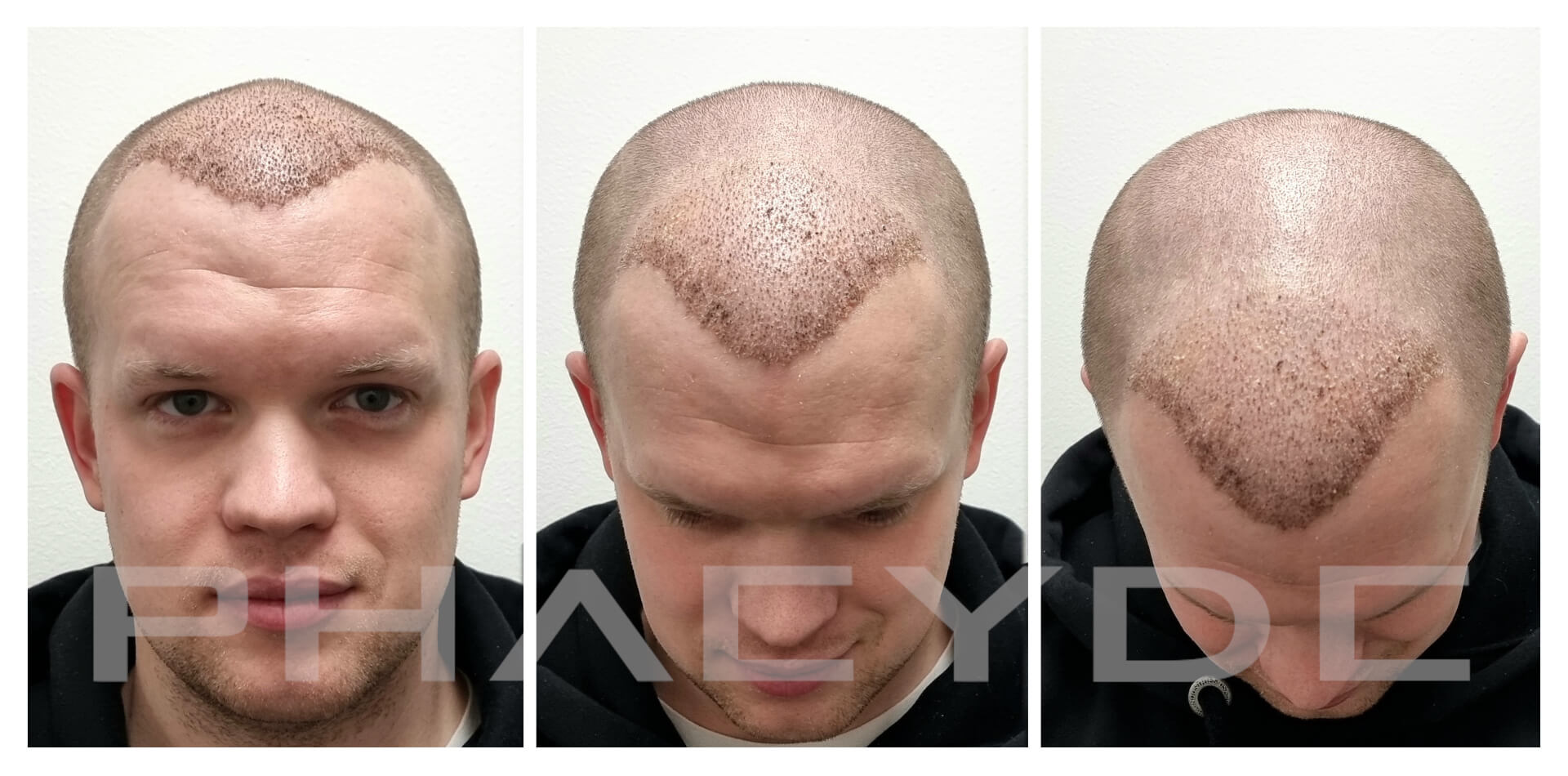 PHAEYDE Hair Transplant Clinic