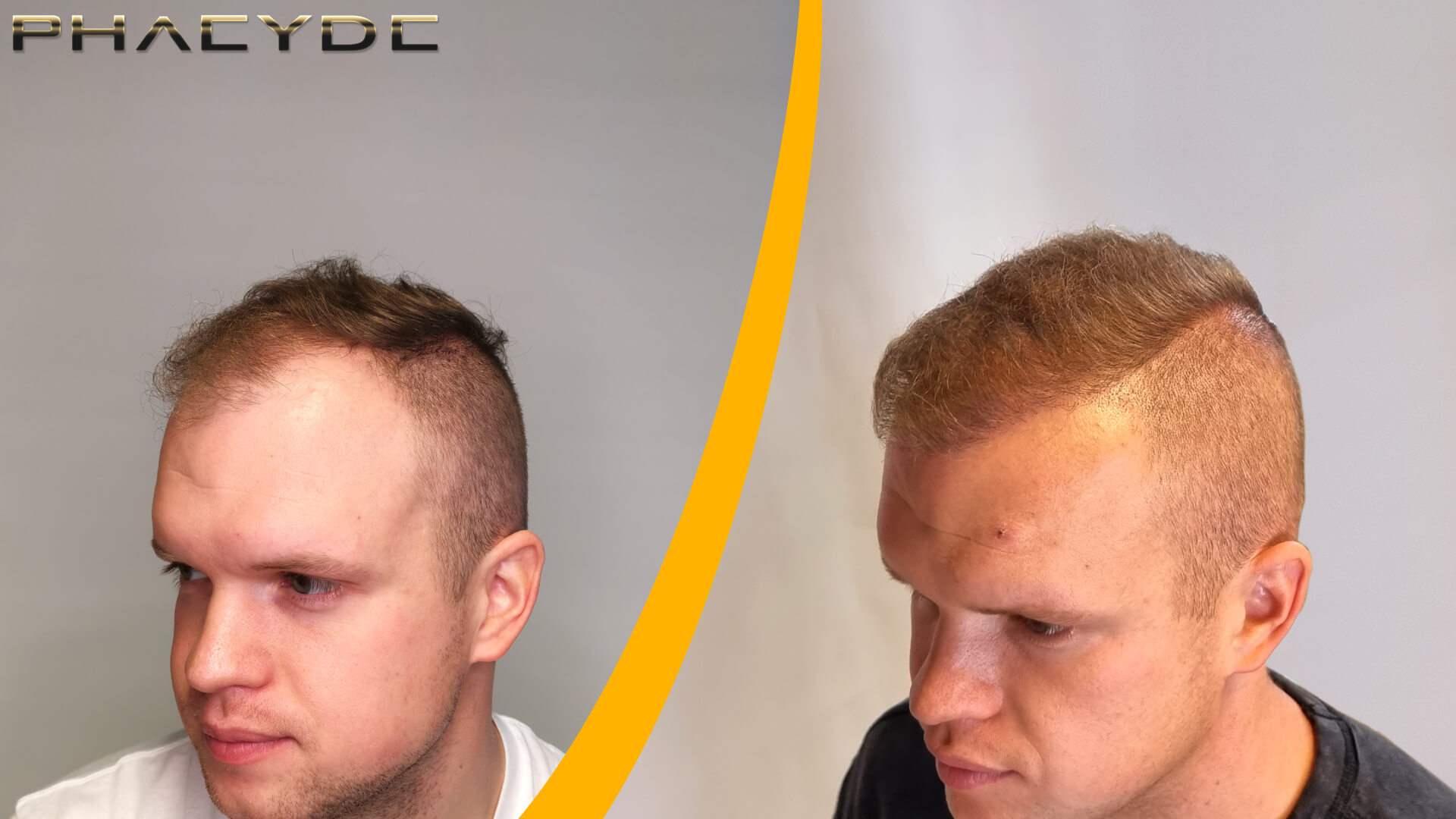 Patrik: Antes y Después del Trasplante de Cabello