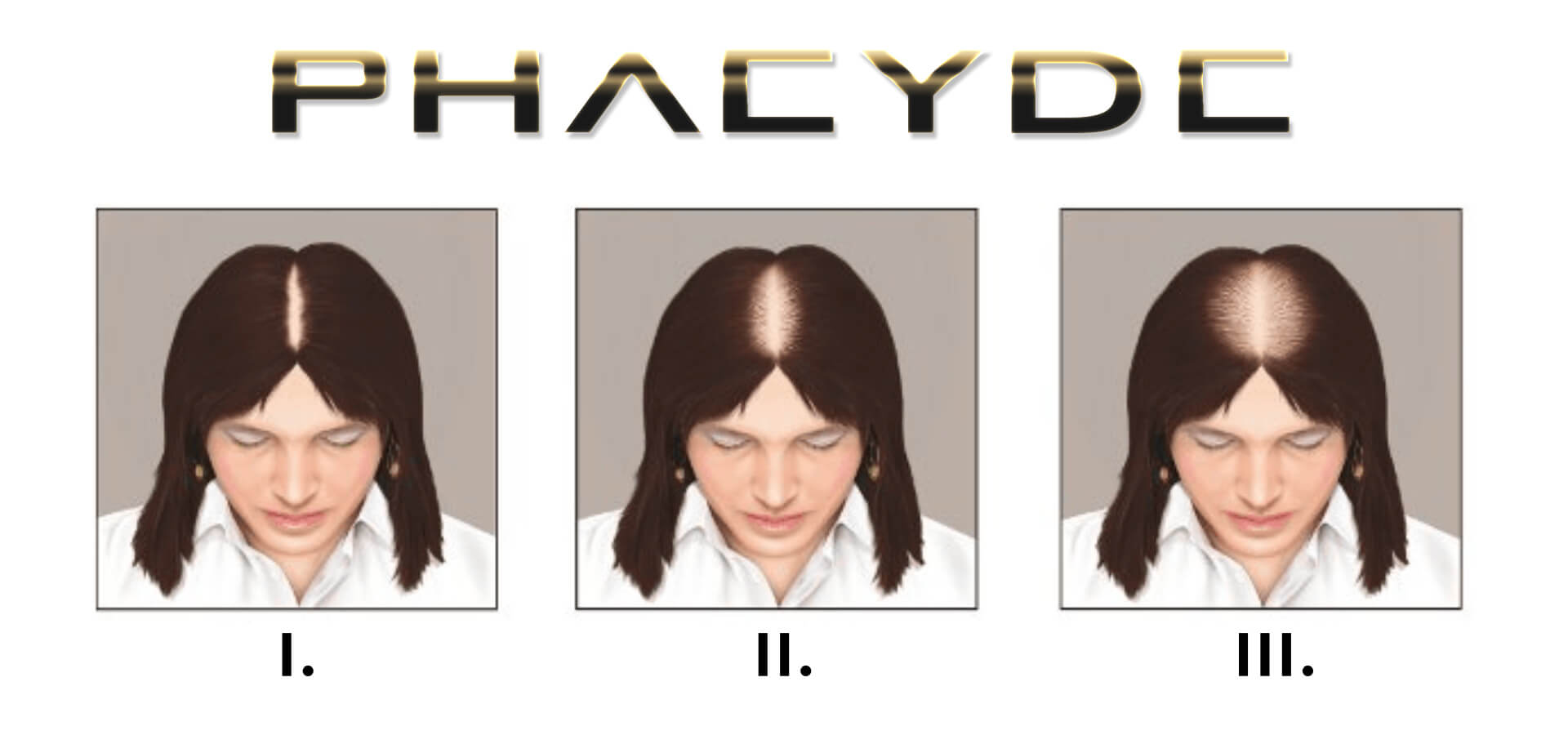 Escala de Ludwig: Etapas de la Pérdida de Cabello en Mujeres