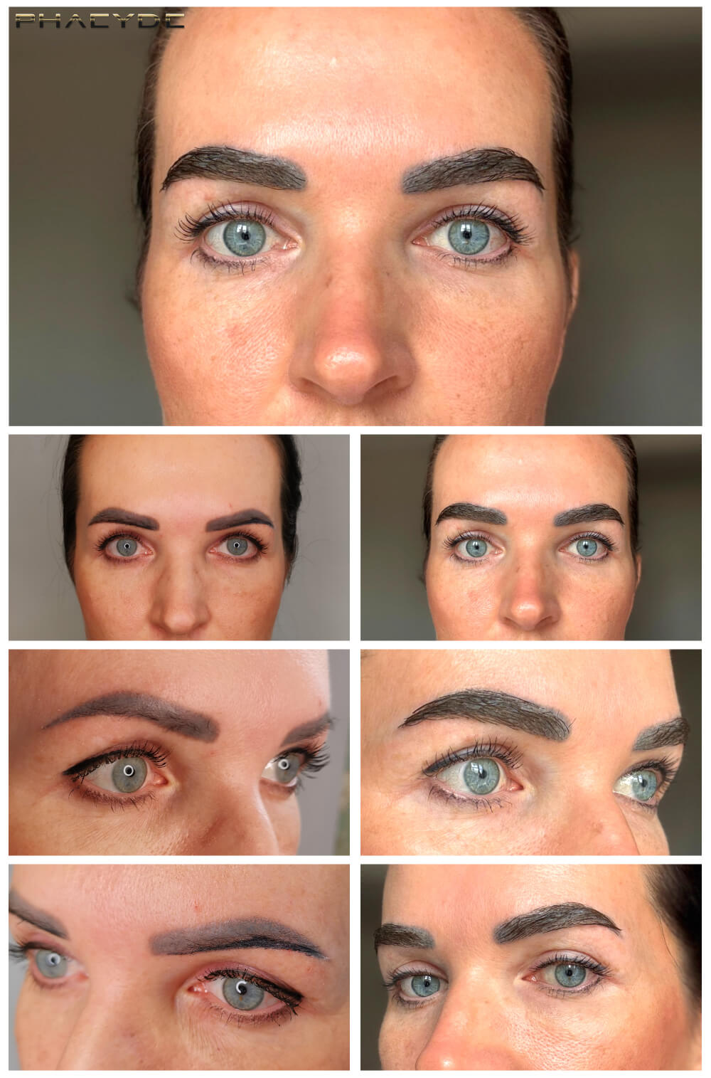 Trasplante de cejas