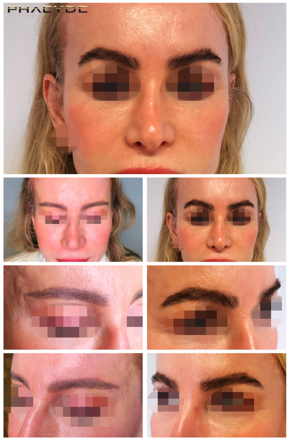 Trasplante de cejas