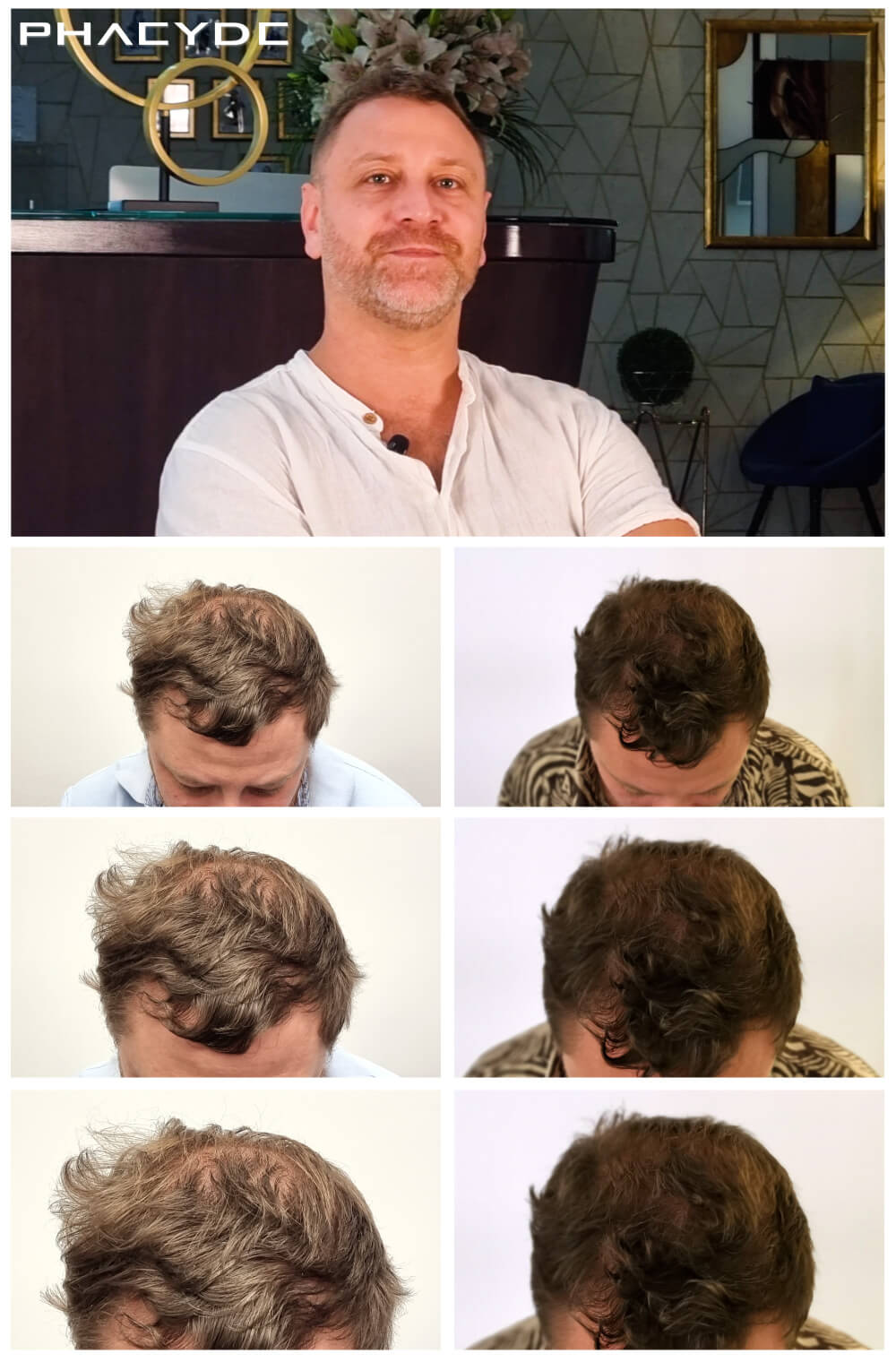 i/hair-transplantation/before-after-photos/hair-transplant-before-after-gabor-phaeyde-clinic.jpg