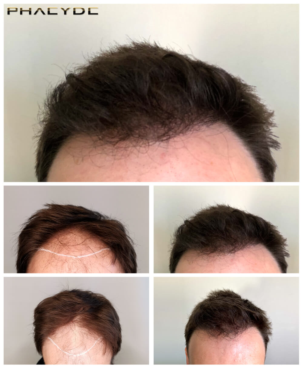 i/hair-transplantation/before-after-photos/hair-transplant-before-after-juraj-phaeyde-clinic.jpg