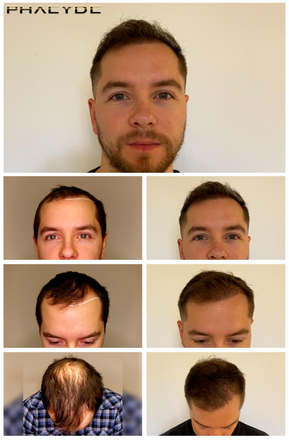 Štefan - 2200 Grafts