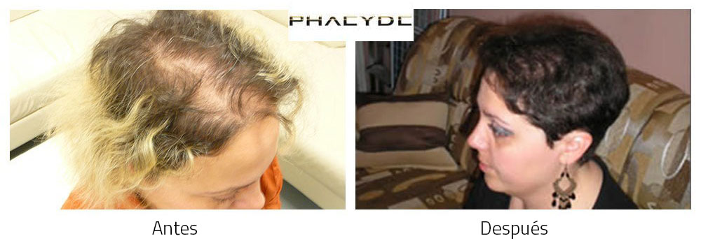 Transplante de cabello Christina T. 5000+ Pelo