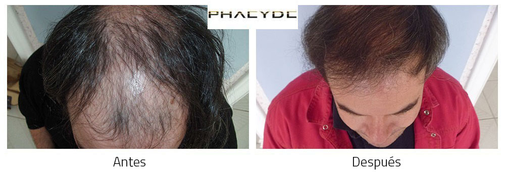 Transplante de cabello Peter Molnar Kalloy 4000 Pelo