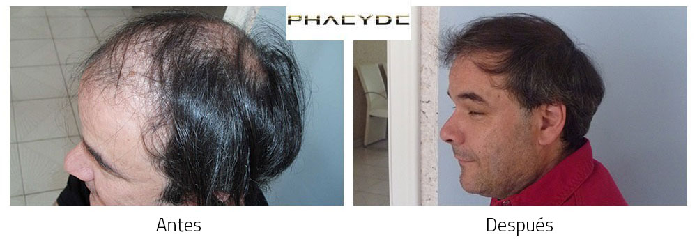 Transplante de cabello Peter Molnar Kalloy 4000 Pelo