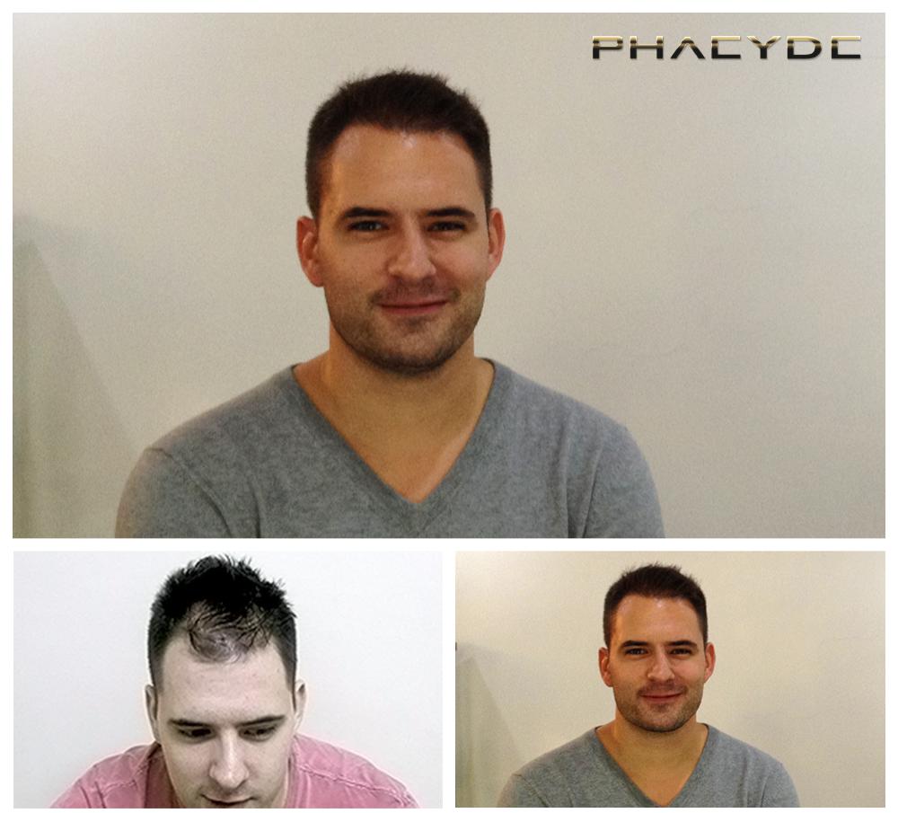 Transplante de cabello fue pelo resultados antes despues imagenes andras somogyi - PHAEYDE Clínica
