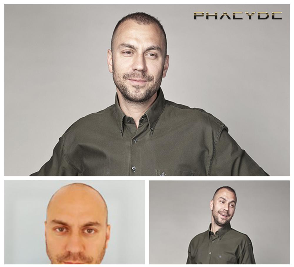Transplante de cabello fue pelo resultados antes despues imagenes attila csenki - PHAEYDE Clínica