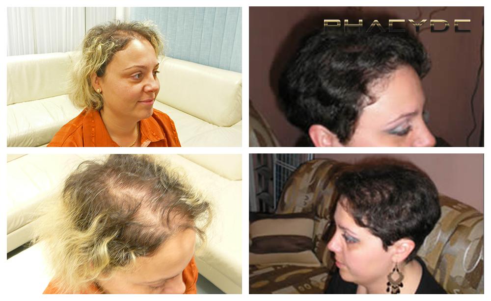 Transplante de cabello fue pelo resultados antes despues imagenes christina torok woman - PHAEYDE Clínica