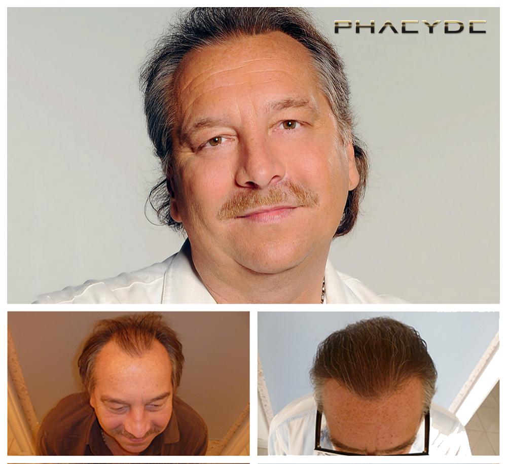 Transplante de cabello fue pelo resultados antes despues imagenes imre bajor - PHAEYDE Clínica