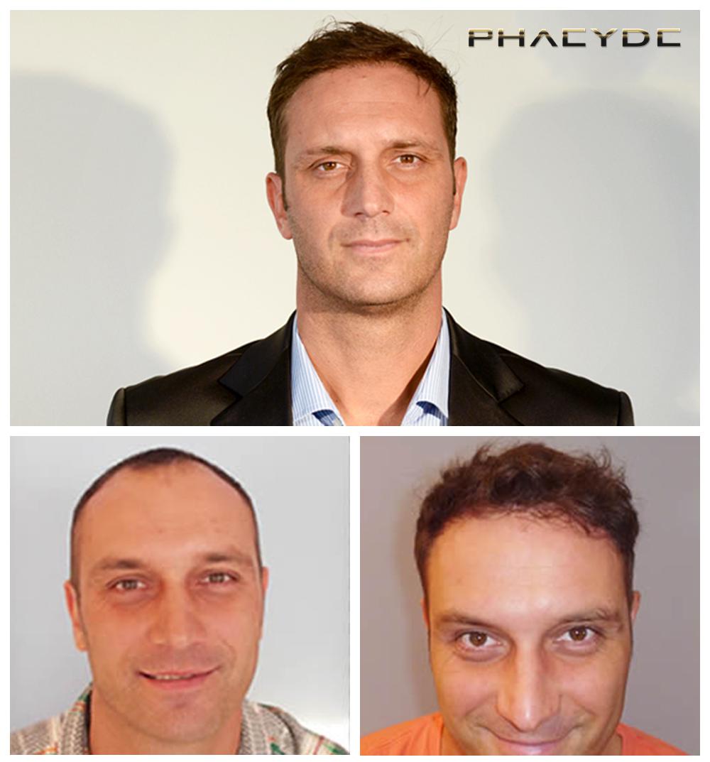 Transplante de cabello fue pelo resultados antes despues imagenes istvan szebeni - PHAEYDE Clínica