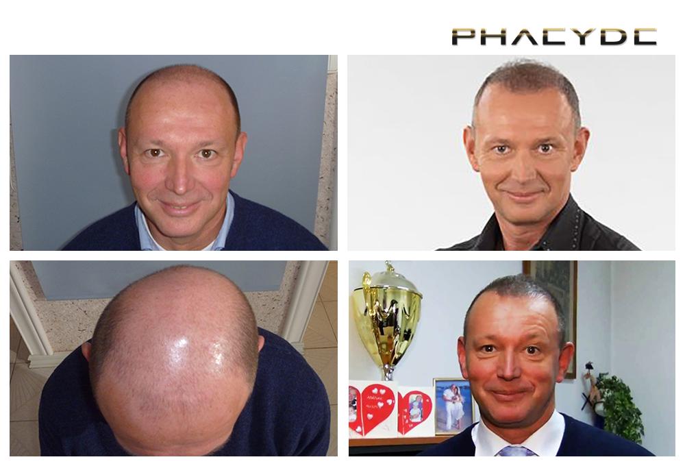 Transplante de cabello fue pelo resultados antes despues imagenes pal gyorfi - PHAEYDE Clínica