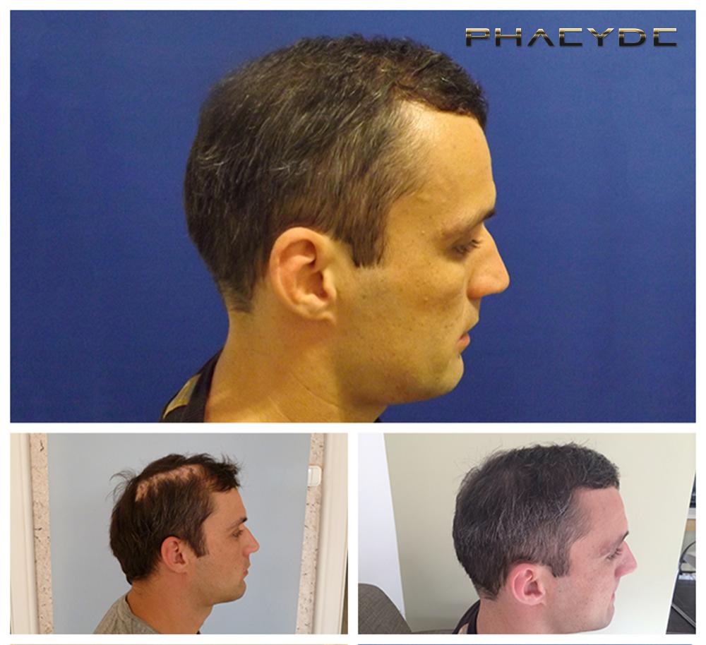 Transplante de cabello fue pelo resultados antes despues imagenes peter p gallery - PHAEYDE Clínica