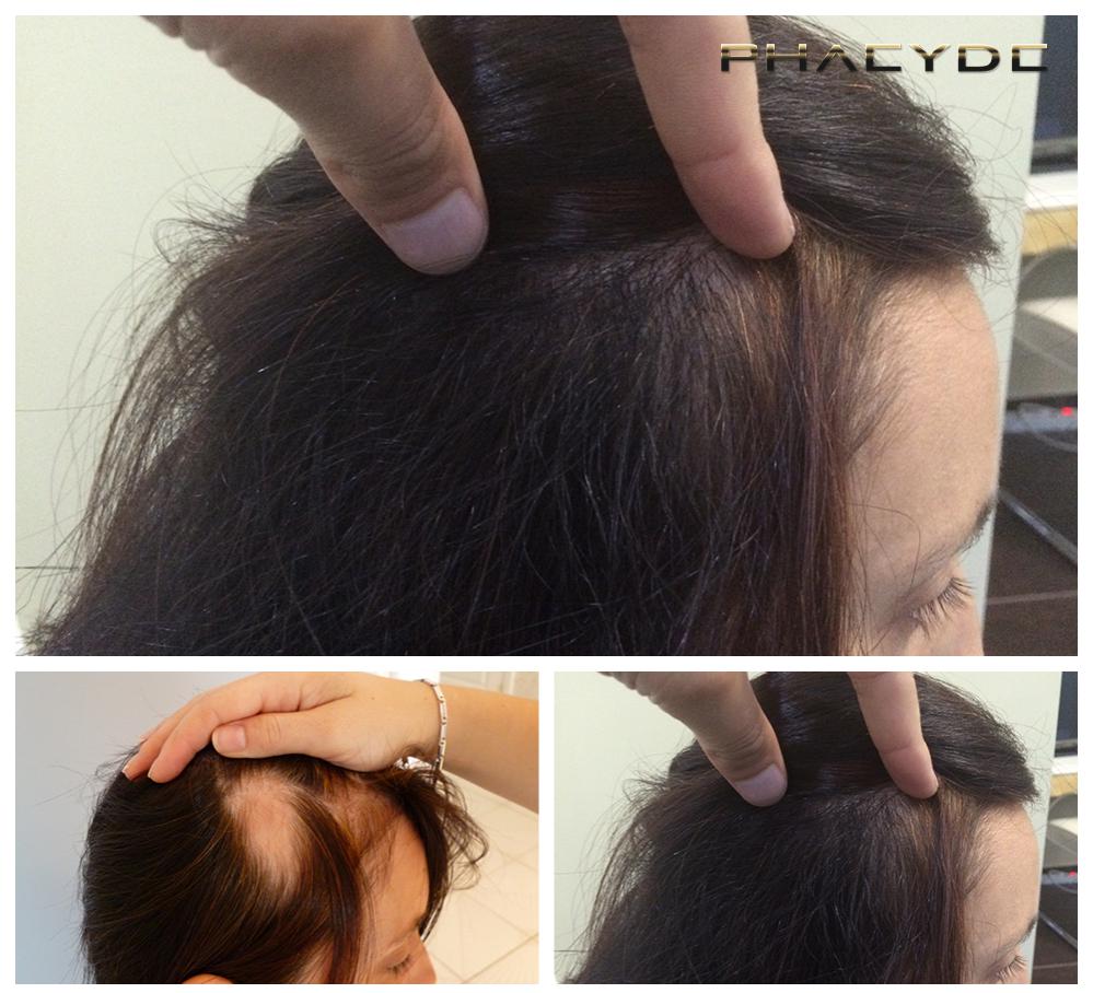 Transplante de cabello fue pelo resultados antes despues imagenes reka d - PHAEYDE Clínica
