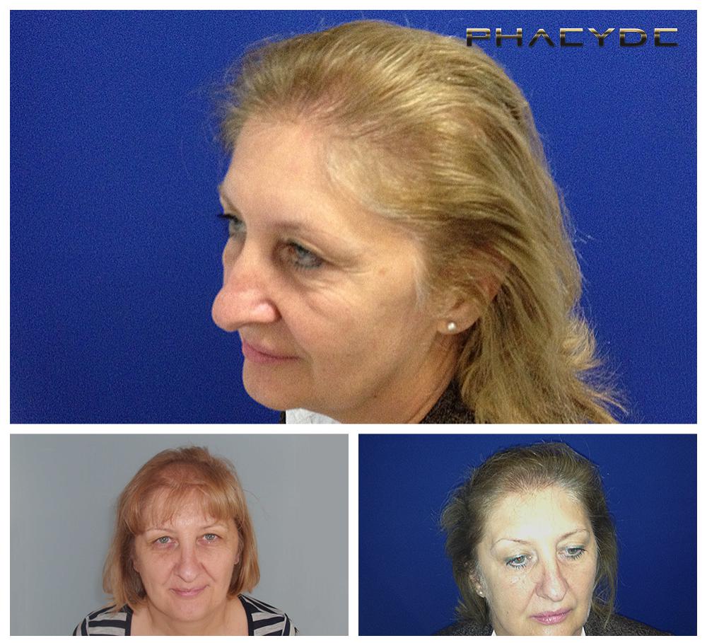 Transplante de cabello fue pelo resultados antes despues imagenes susanne mikola - PHAEYDE Clínica