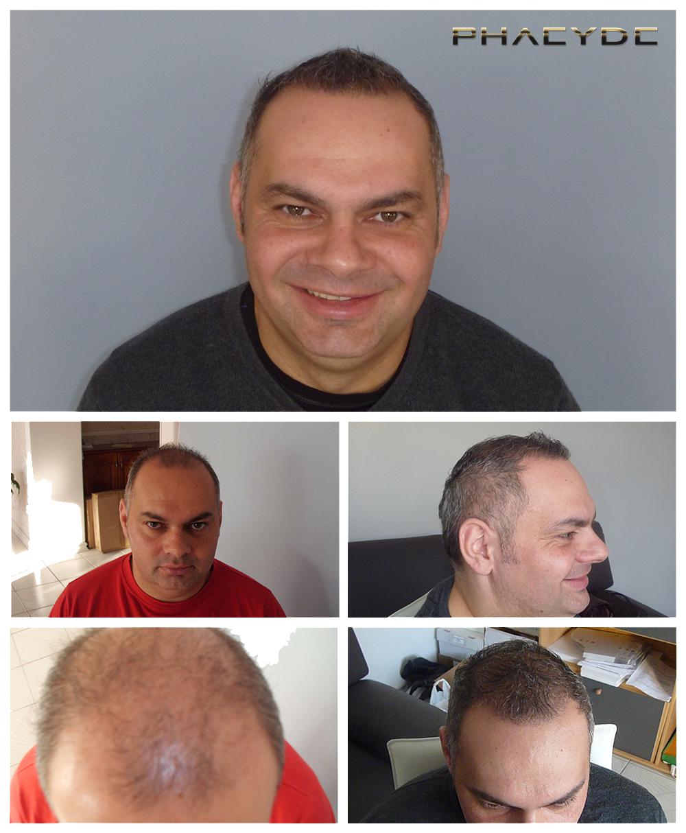 Transplante de cabello fue pelo resultados antes despues imagenes zoltan lencse - PHAEYDE Clínica