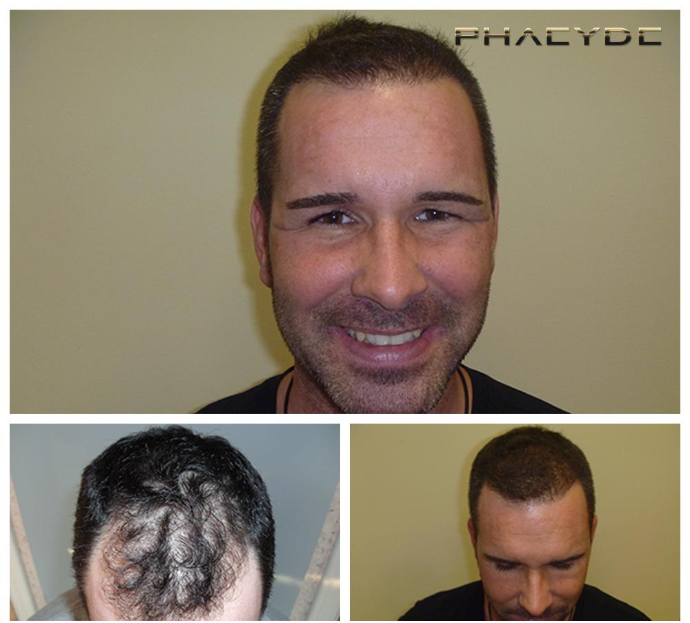 Transplante de cabello fue pelo resultados antes despues imagenes zsolt vincze - PHAEYDE Clínica